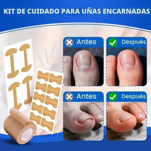 Vista 7 de Kit de cuidado de uñas encarnadas con tiras flexibles (134 piezas), kit de herramientas profesional para uñas de los pies incluye bandas