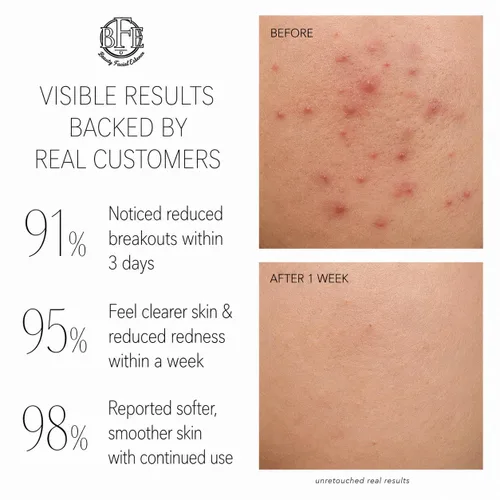 Vista 5 de Crema para el tratamiento del acné en los glúteos, brotes claros, espinillas, manchas oscuras y pelos encarnados para glúteos y muslos, suaviza