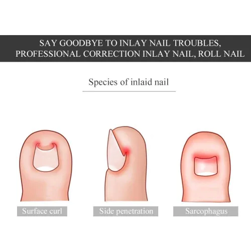 Vista 9 de Corrector de uñas pedicura herramienta de cuidado de pies, 12 unids/caja de herramienta de corrección de uñas de los pies, 6 tamaños encarnados
