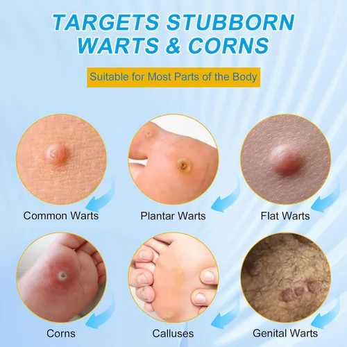 Vista 4 de WART Almohadillas removedoras de maíz para pies, 40% ácido salicílico, almohadillas removedoras de maíz para dedos de los pies, cuerpo