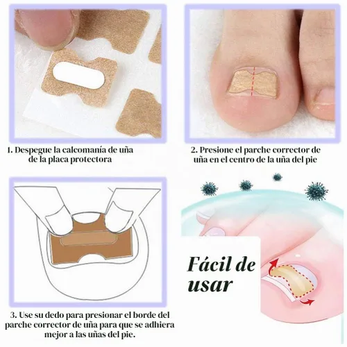 Vista 5 de Parche de corrección de uñas encarnadas, 50 calcomanías de uñas encarnadas sin pegamento para uñas encarnadas curvadas para el cuidado de los pies