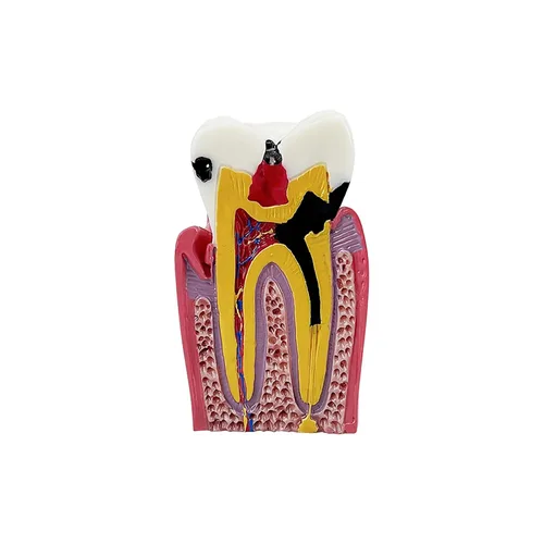 Vista 5 de Modelo de dientes de caries dental, modelo YOUYA DENTAL 6 veces de dientes de caries modelo de anatomía dental para educación de dientes