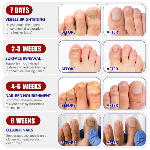 Vista 5 de Parches de uñas, 32 parches para el cuidado de las uñas de los pies para uñas secas, débiles y agrietadas, uñas profundamente hidratantes, protegen