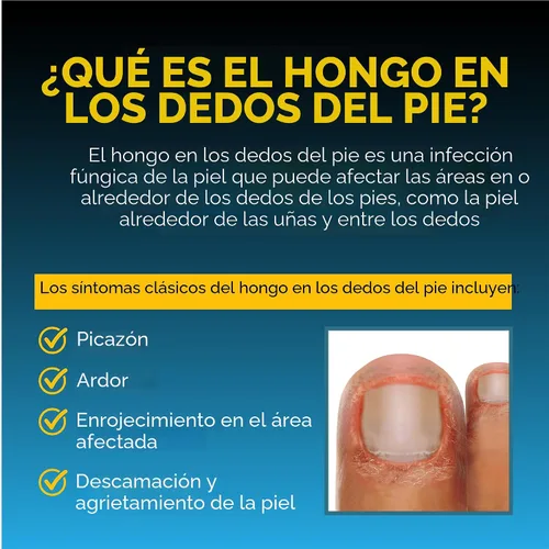 Vista 5 de Pomada Fungi Nail para hongo de dedo y pie (0.70 onzas), 17450, paquete de de 1, 1, 1 Mata el hongo del dedo del pie con tolnaftato y clínicamente