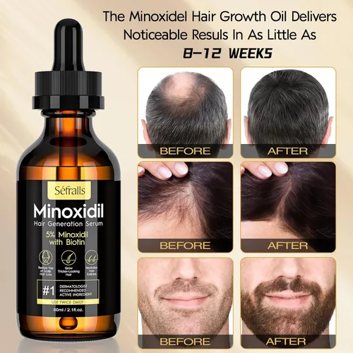 Vista 3 de Kit de aceite de crecimiento del cabello de minoxidil al 5% para hombres y mujeres, suero de crecimiento extra fuerte, suero tópico para tratamiento