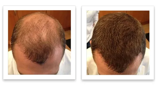 Vista 5 de Solución para cabello ralo - Fibras totalmente naturales a base de plantas para una apariencia más completa y gruesa. Cubre instantáneamente