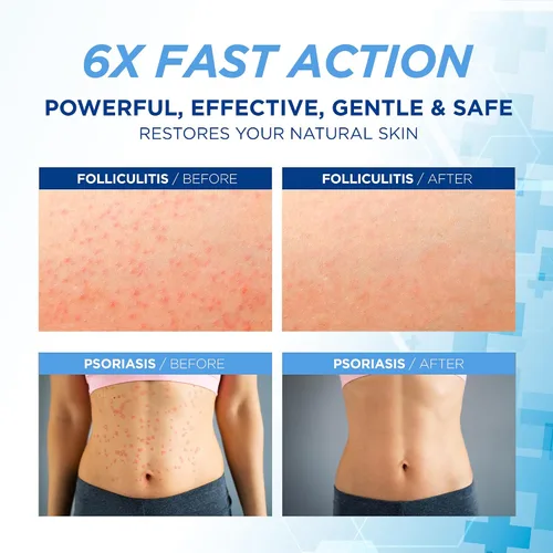 Vista 2 de Crema Tratamiento de Foliculitis Tratamiento Eficaz para Foliculitis Cuero Cabelludo Cara y Cuerpo 3.53 oz