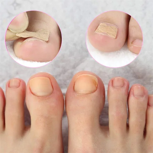 Vista 8 de Parche de corrección de uñas encarnadas, 50 calcomanías de uñas encarnadas sin pegamento para uñas encarnadas curvadas para el cuidado de los pies
