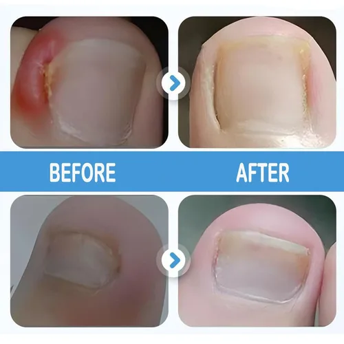 Vista 3 de Juego profesional de uñas encarnadas con tiras transpirables de uñas encarnadas, tiras correctoras de uñas de los pies, parche corrector de uñas