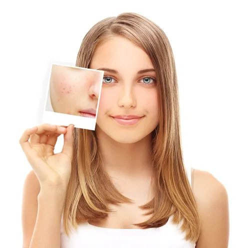 Vista 5 de Babyface 30% ácido salicílico químico Peel – Beta hidroxiácido extra fuerte para acné, eliminación de puntos negros y exfoliación, sin alcohol, 1.2