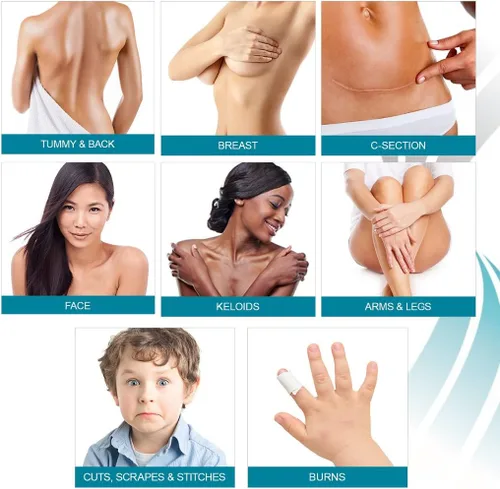 Vista 5 de NewGel - Cinta profesional de silicona avanzada para tratamiento de cicatrices por MyNewGel, ultra gruesa, para abdomen, sección C, queloides