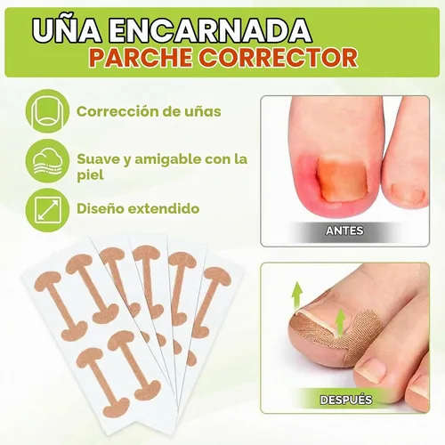 Vista 3 de Kit corrector de uñas encarnadas, herramientas de uñas, tiras de corrección transpirables con herramientas de levantamiento de uñas, cortaúñas