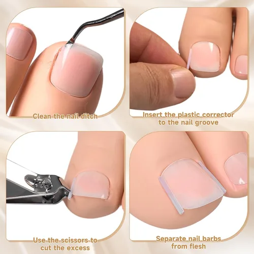 Vista 6 de Kit corrector de uñas encarnadas de 201 piezas con tiras de corrección transpirables, parches de uñas curvas, herramientas levantadoras de uñas