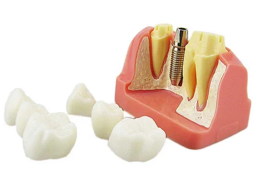 Vista 2 de Dental Implante Estudio Análisis Puente Corona Demostración Dientes