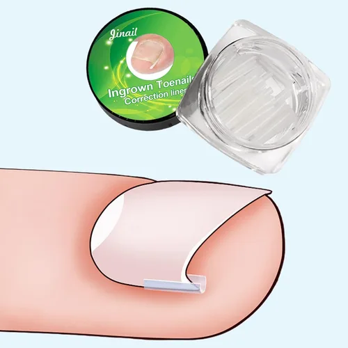 Vista 3 de Kit de tiras correctoras de uñas encarnadas, 10 piezas de tiras correctoras de uñas encarnadas, tiras alisadoras de uñas encarnadas, clips