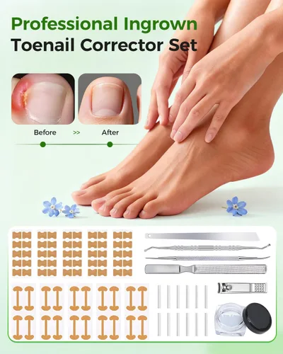 Vista 5 de Juego de corrector de uñas encarnadas con tiras correctoras, kit de eliminación de uñas encarnadas, parche corrector, herramientas de pedicura