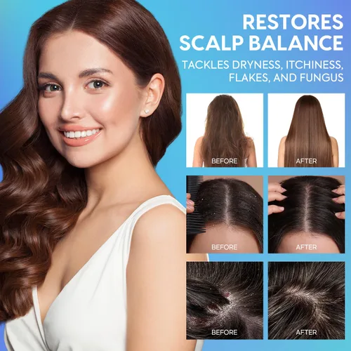 Vista 2 de Acondicionador para la caspa para el cabello y el cuero cabelludo seco: hidratación profunda y alivio calmante con ingredientes naturales, calma
