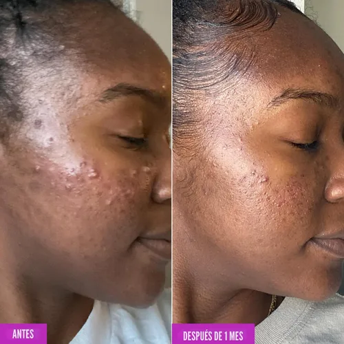 Vista 5 de Good Molecules - Limpiador espumoso para el acné - Limpiador espumoso con 2% de ácido salicílico - Lavado facial suave para el acné con hamamelis