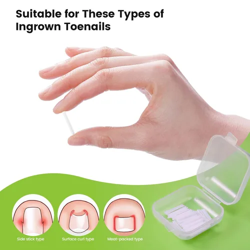 Vista 4 de BEZOX Juego de corrector de uñas encarnadas con cuchilla recta, 40 tiras alisadoras de uñas sin dolor con levantador de uñas de los pies, kit