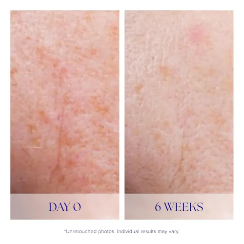 Vista 5 de iS CLINICAL Suero activo: unifica visiblemente el tono de la piel, excelente para pieles propensas al acné, suero facial antienvejecimiento