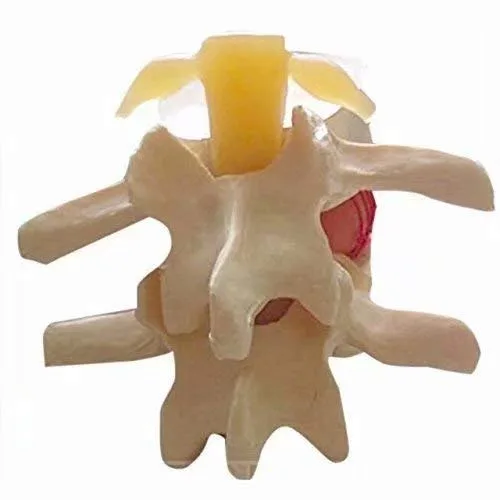 Vista 4 de Modelo de demostración de hernia de disco lumbar humana Modelo anatómico de la columna vertebral humana Amarillo