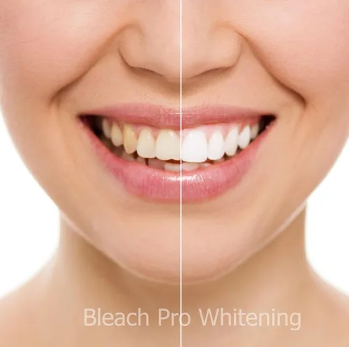 Vista 4 de Dispensadores de jeringas de gel blanqueador de dientes 22% de peróxido de carbamida, 10 jeringas de gel blanqueador de dientes de 0.1 fl oz