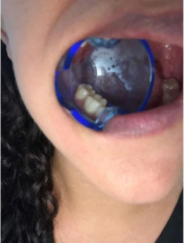 Vista 6 de Retractor de mejilla de ortodoncia dental expansor de boca autoclavable para dientes posteriores (15 piezas/lote)