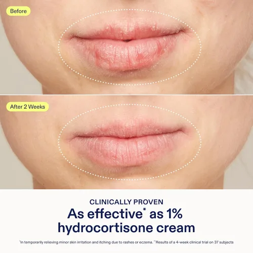 Vista 4 de Skinfix Bálsamo para aliviar la dermatitis con 5% de avena coloidal y vitamina E - 1.7 onzas líquidas - Probado eficaz como hidrocortisona al 1%