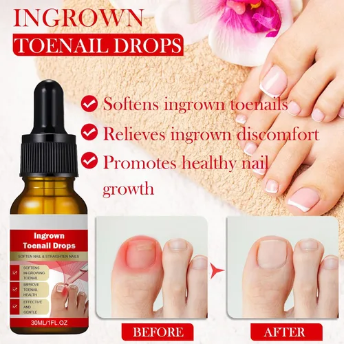 Vista 3 de Kit de eliminación de uñas encarnadas, tratamiento profesional de uñas encarnadas, kit de herramientas de uñas encarnadas con gotas correctoras