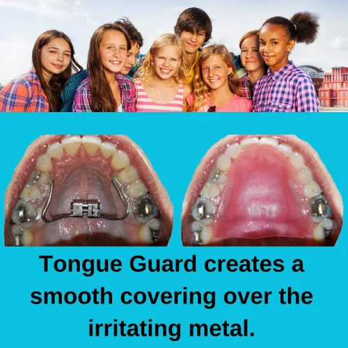 Vista 2 de Protector de lengua EP: previene y ayuda a curar las llagas de la lengua causadas por expansores dentales