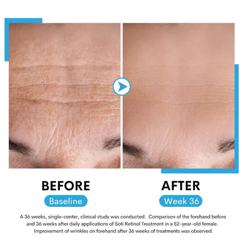 Vista 2 de Suero facial de retinol, reduce arrugas, manchas de edad, marcas postacné. Estimula el colágeno, piel firme, antienvejecimiento con ácido