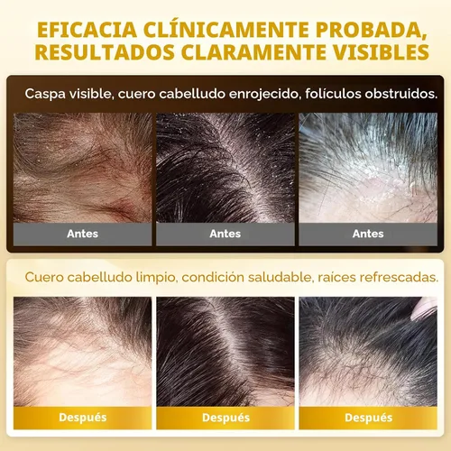Vista 6 de Champú antifúngico mejorado para dermatitis seborreica, foliculitis y psoriasis del cuero cabelludo, champú anticaspa para hombres y mujeres, alivia