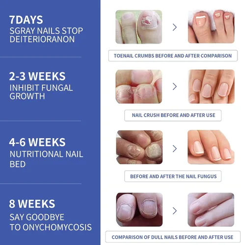 Vista 5 de Tratamiento de hongos en las uñas de los pies, extra fuerte, tratamiento de hongos en las uñas, extra fuerte, solución de reparación de uñas