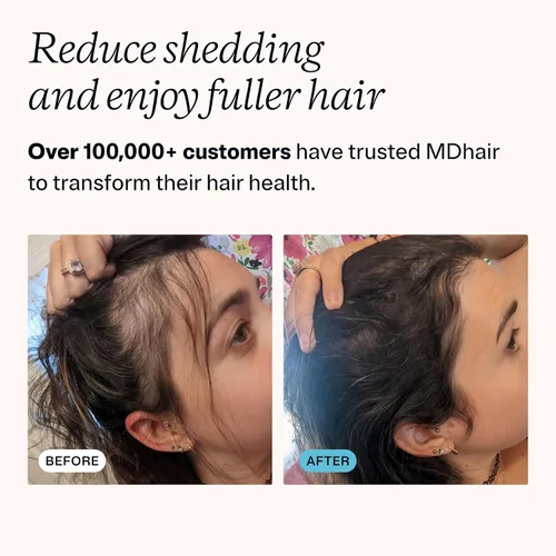 Vista 6 de MDhair Paquete de cabezal de ducha filtrado montado y de mano para cabello y piel más saludables. Filtro de varias etapas que elimina el cloro