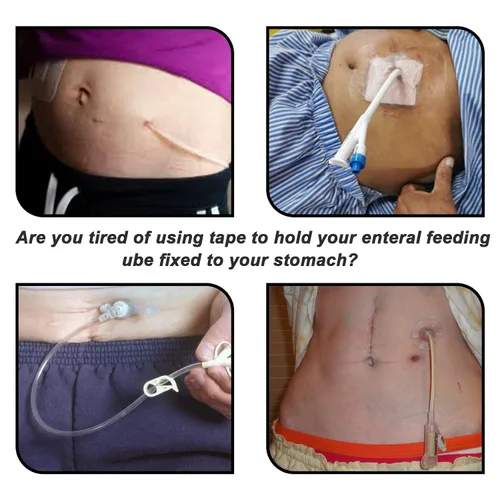 Vista 5 de EDWERD Cinturón de soporte de tubo G, cinturón de diálisis peritoneal para accesorios de tubo de alimentación Peg/G/J, suministros para pacientes