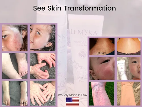 Vista 5 de Crema de rosácea: loción de erupción facial para aliviar el enrojecimiento facial para eccema, psoriasis, urticaria y piel seca, curación natural