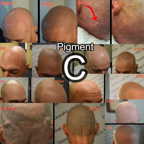 Vista 4 de Kit completo de micropigmentación del cuero cabelludo de DermMicro