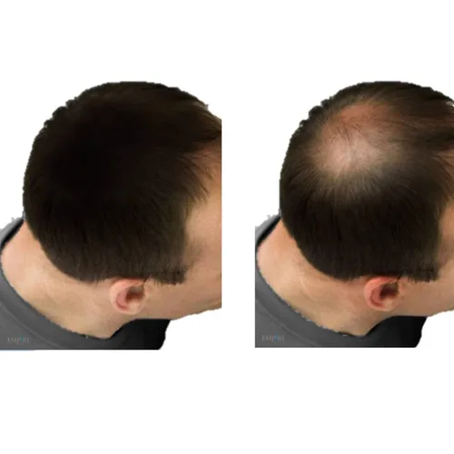Vista 3 de Empire Hair Max - Corrector de pérdida de queratina para aumentar la pérdida de queratina (0.88 onzas) (gris)