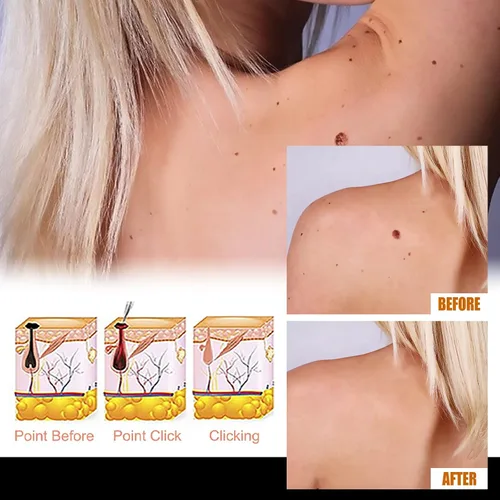 Vista 4 de Suero eliminador de verrugas profesional con ácido salicílico, para verrugas comunes en pies, manos y cuerpo, formulado con glicerina y pantenol(1)