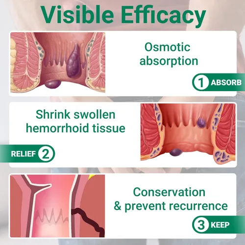 Vista 6 de LMNOOP® Ungüento para tratamiento de hemorroides, tratamiento de máxima fuerza y alivio rápido para el dolor, picazón, ardor, hinchazón, fisura