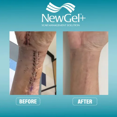 Vista 8 de NewGel - Cinta profesional de silicona avanzada para tratamiento de cicatrices por MyNewGel, ultra gruesa, para abdomen, sección C, queloides