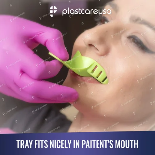 Vista 3 de Bandejas de impresión dental grandes inferiores - Juego de bandejas de impresión perforadas autoclavables - Tamaño número 2 (Bolsa de 12)