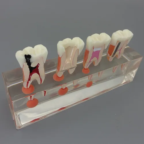 Vista 8 de Modelo de dientes dentales Modelo de tratamiento endodóntico de 4 etapas para estudiar y enseñar..