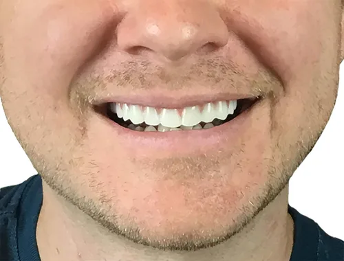 Vista 2 de Instant Smile Ajuste Cómodo Flex Tono Natural