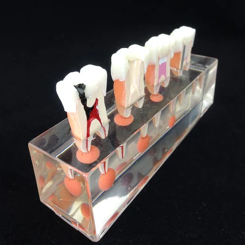 Vista 5 de Modelo de dientes dentales Modelo de tratamiento endodóntico de 4 etapas para estudiar y enseñar..