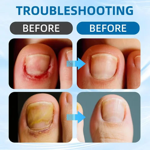 Vista 2 de Corrector de uñas encarnadas, kit de herramientas profesionales para uñas encarnadas con tiras de uñas de los pies, parche corrector de uñas curvas