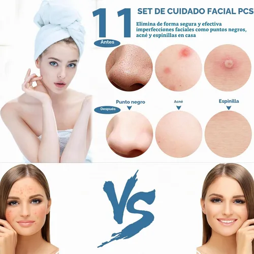 Vista 2 de Kit de herramientas para eliminar puntos negros, herramienta extractora de espinillas, herramienta extractora de espinillas, herramienta profesional