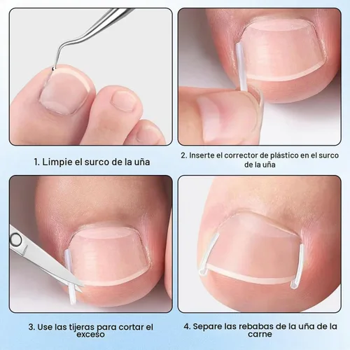 Vista 7 de Juego de corrector de uñas encarnadas con tiras correctoras, kit de eliminación de uñas encarnadas, parche corrector, herramientas de pedicura