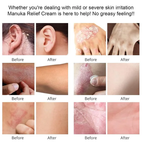Vista 6 de Crema orgánica de loción de miel de manuka con avena coloidal, hidratante calmante para piel seca, para alivio, eccema de manos y cuerpo, psoriasis
