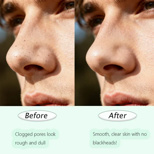 Vista 4 de 2 piezas de herramienta de eliminación de puntos negros, espátula facial de doble cabeza para limpieza profunda de los poros de la nariz y la zona